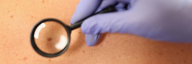 Czy dermatoskopia wykryje grzybicę skóry?